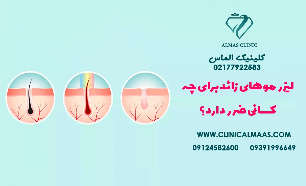 لیزر موهای زائد برای چه کسانی ضرر دارد؟